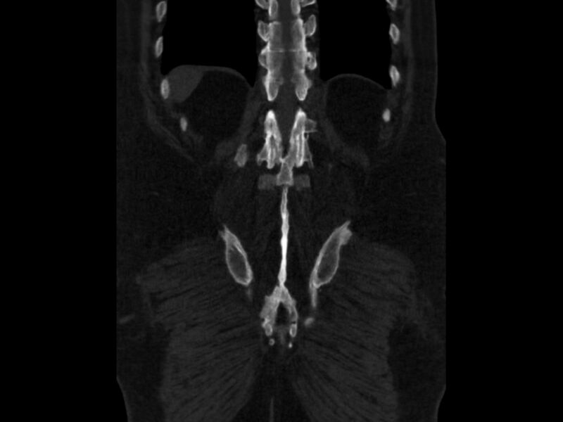File:Ankylosing spondylitis (Radiopaedia 44609-48357 Coronal bone window 87).jpg