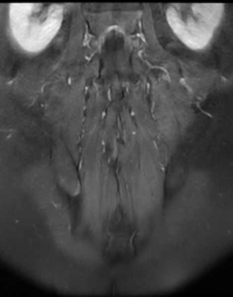 File:Ankylosing spondylitis - Andersson lesion (Radiopaedia 81878-95838 H 12).jpg