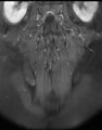 Ankylosing spondylitis - Andersson lesion (Radiopaedia 81878-95838 H 12).jpg