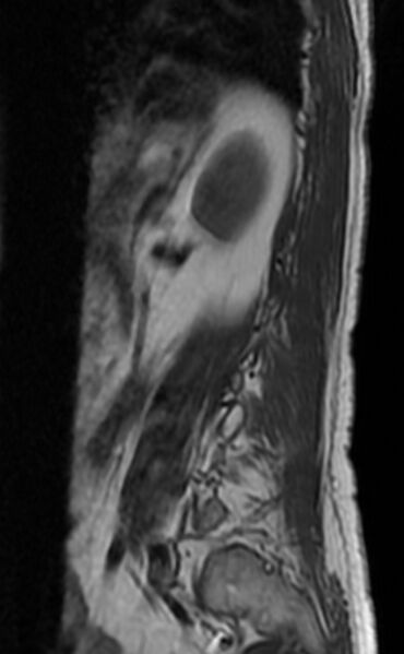 File:Ankylosing spondylitis - Andersson lesion (Radiopaedia 81878-95838 Sagittal T1 12).jpg