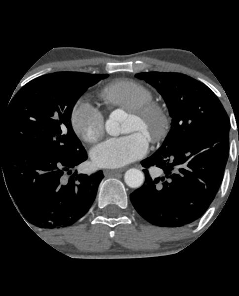 File:Anomalous coronary arteries (Radiopaedia 83979-99206 A 160).jpg