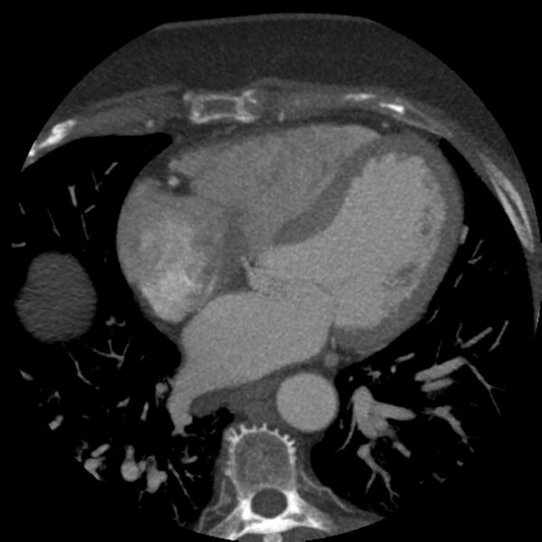 File:Anomalous origin of left circumflex artery from right coronary sinus (Radiopaedia 72563-83117 A 28).jpg