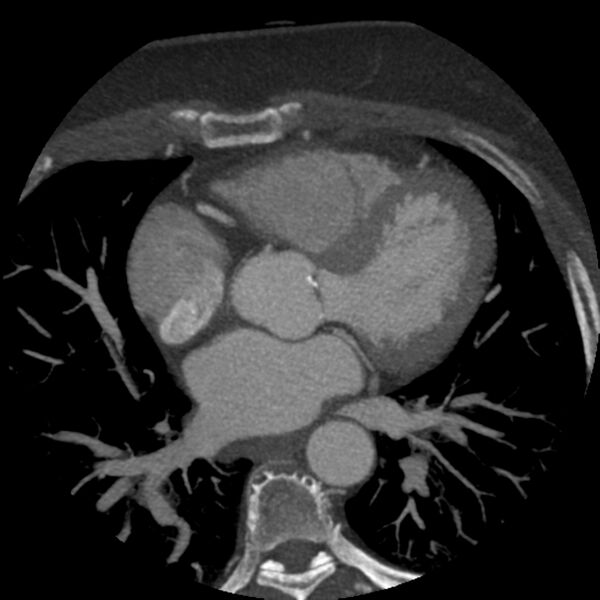 File:Anomalous origin of left circumflex artery from right coronary sinus (Radiopaedia 72563-83117 A 35).jpg