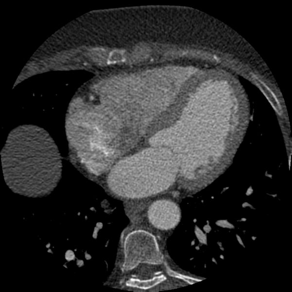 File:Anomalous origin of left circumflex artery from right coronary sinus (Radiopaedia 72563-83117 B 98).jpg