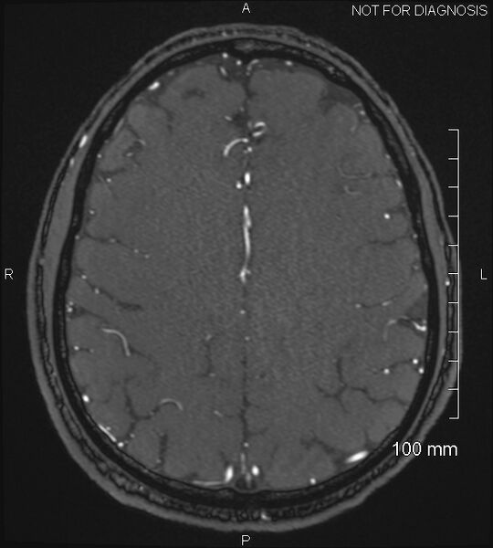 File:Anterior cerebral artery aneurysm (Radiopaedia 80683-94127 Axial MRA 177).jpg