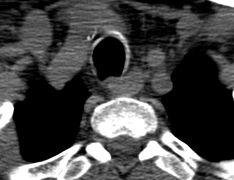 File:Anterior cervical postdiscectomy arthrodesis (Radiopaedia 32678-33646 Axial non-contrast 72).jpg