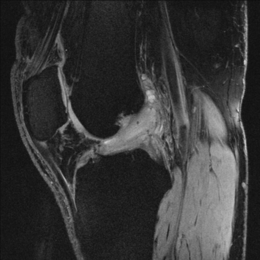 Anterior cruciate ligament mucoid degeneration (Radiopaedia 68400-77933 Sagittal 31).jpg