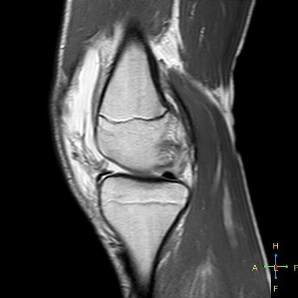 File:Anterior cruciate ligament tear - complete (Radiopaedia 24907-25170 Sagittal PD 12).jpg