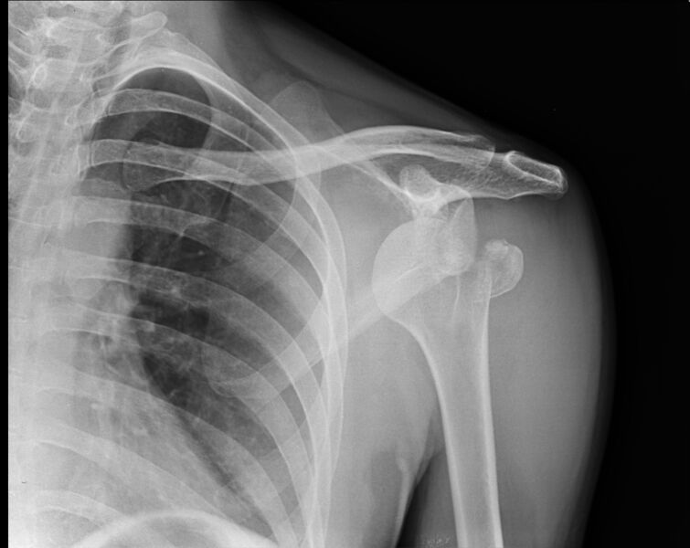 File:Anterior shoulder dislocation with fracture of greater tuberosity of humeral head (Radiopaedia 12197-12522 Frontal 1).jpg