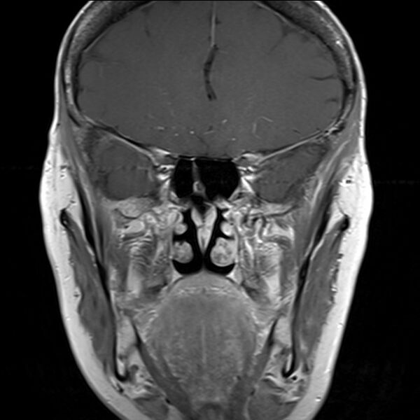 File:Anterior temporal encephalocele (Radiopaedia 82624-96808 Coronal T1 1).jpg