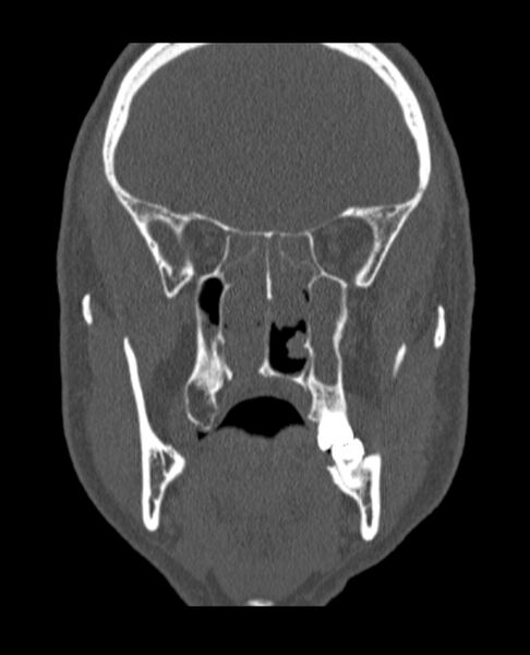 File:Antrochoanal polyp (Radiopaedia 79011-92169 Coronal bone window 36).jpg