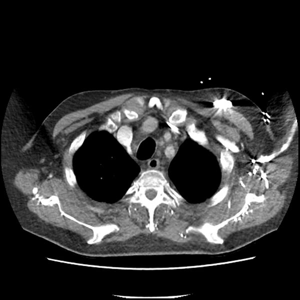 File:Aortic arch graft infection (FDG PET-CT) (Radiopaedia 71975-82437 A 7).jpg