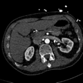Aortic dissection - DeBakey type II (Radiopaedia 64302-73082 A 98).png