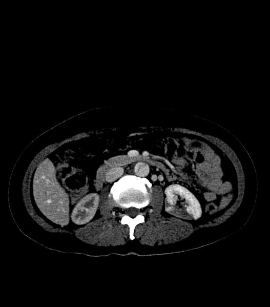 File:Aortic dissection with renal ischemia (Radiopaedia 76573-88338 B 39).jpg