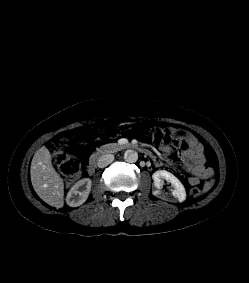 Aortic dissection with renal ischemia (Radiopaedia 76573-88338 B 39).jpg
