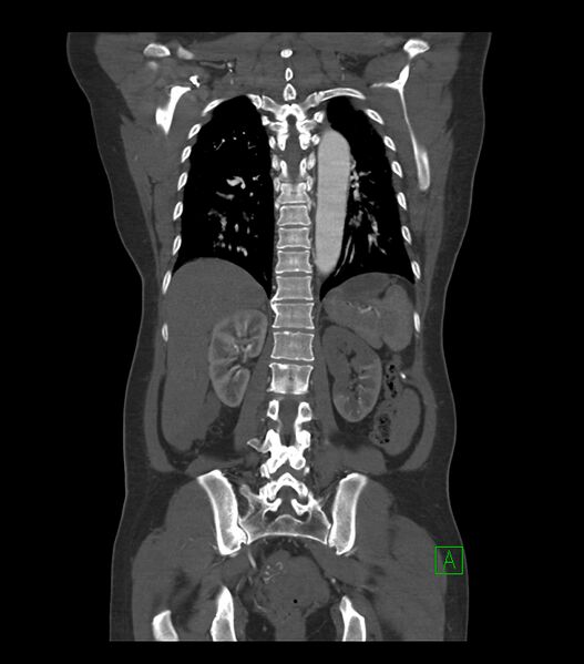 File:Aortic dissection with renal ischemia (Radiopaedia 76573-88338 C 27).jpg