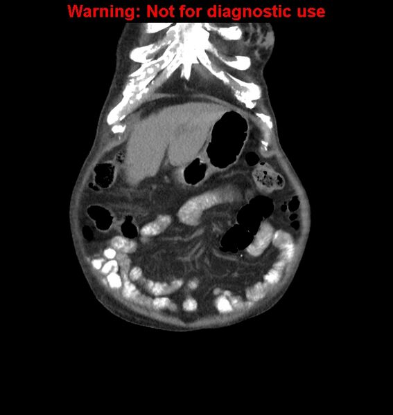 File:Aortic graft infection (Radiopaedia 44979-48907 non-contrast 8).jpg