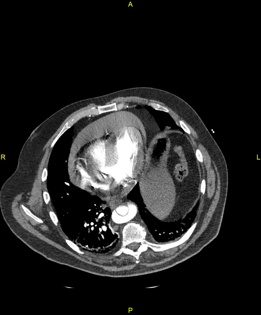 Aortic rupture (Radiopaedia 88822-105594 B 169).jpg