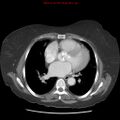Aortic valve stenosis (Radiopaedia 14480-14423 C 8).jpg