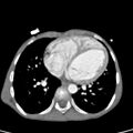 Aortopulmonary window, interrupted aortic arch and large PDA giving the descending aorta (Radiopaedia 35573-37074 B 58).jpg