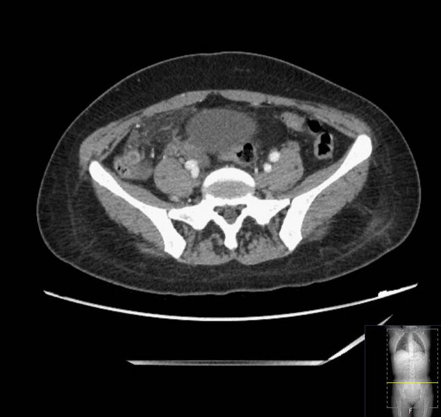 File:Appendicitis (CT angiogram) (Radiopaedia 154713-127660 Axial 17).jpg
