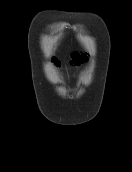 File:Appendicitis and giant appendicolith (Radiopaedia 80251-93588 Coronal non-contrast 2).jpg