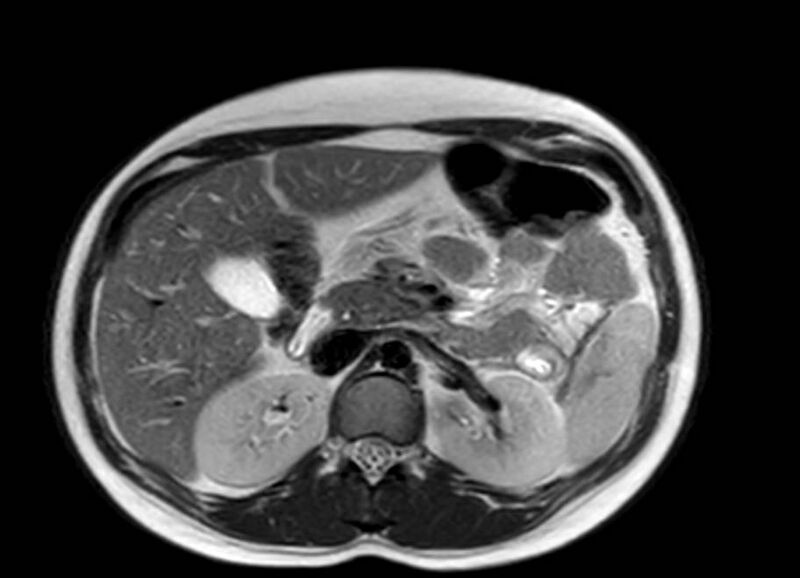 File:Appendicitis in gravida (MRI) (Radiopaedia 89433-106395 Axial T2 20).jpg