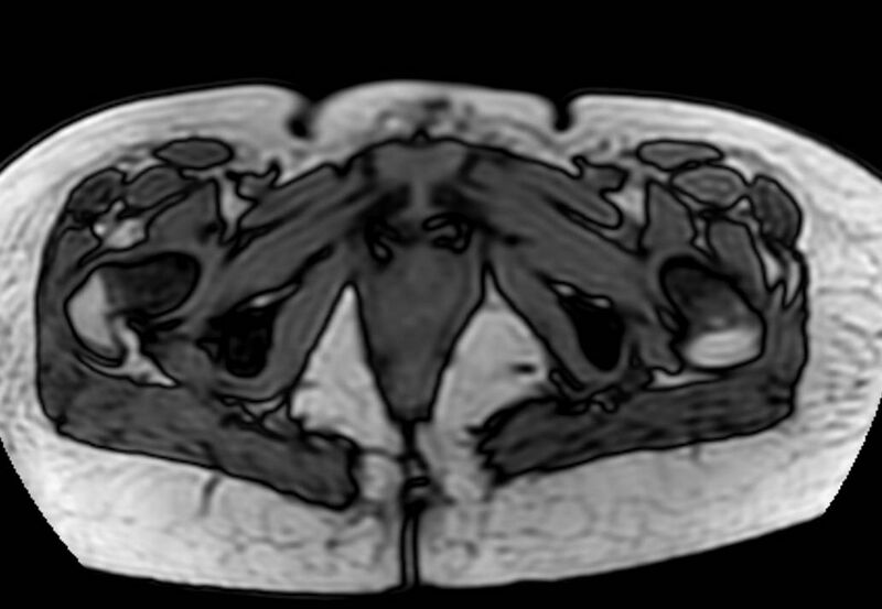 File:Appendicitis in gravida (MRI) (Radiopaedia 89433-106395 D 71).jpg