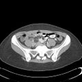 Appendicitis with minimal stranding but appendicolith (Radiopaedia 29035-29397 A 61).jpg