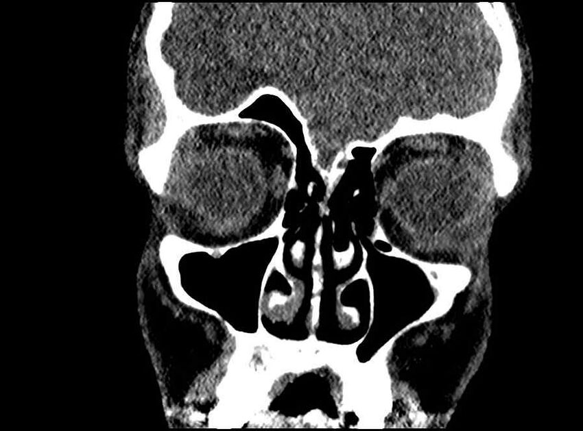 Arachnoid cyst- extremely large (Radiopaedia 68741-78450 Coronal bone window 57).jpg