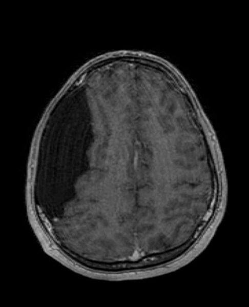 File:Arachnoid cyst- extremely large (Radiopaedia 68741-78451 Axial T1 C+ 59).jpg
