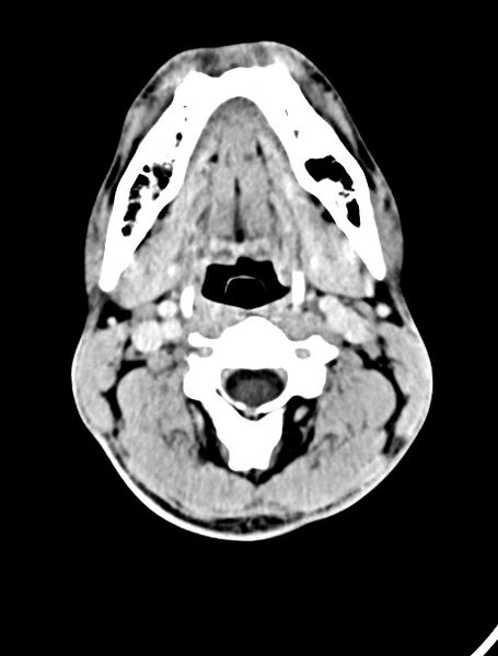 File:Arrow injury to the face (Radiopaedia 73267-84011 Axial C+ delayed 16).jpg