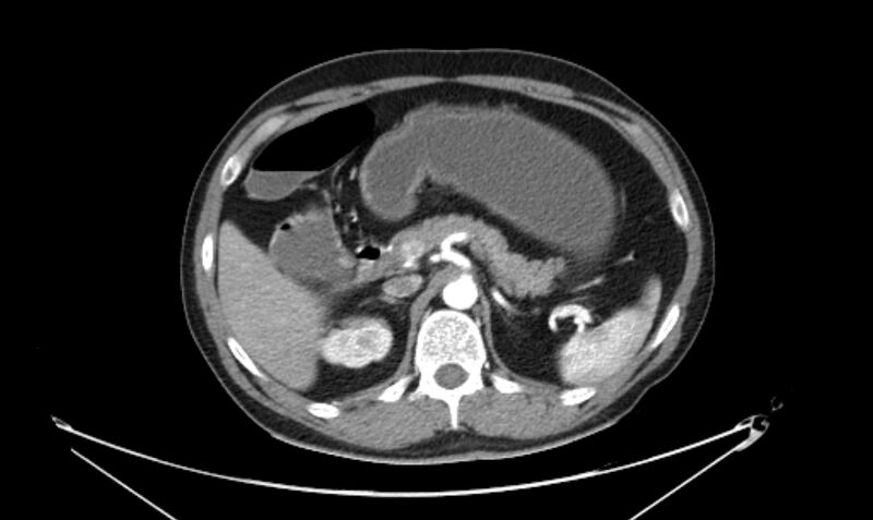 File:Arterial occlusive mesenteric ischemia (Radiopaedia 84641-100060 A 46).jpg