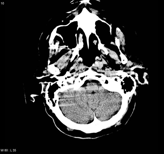 File:Arteriovenous malformation - cerebral (Radiopaedia 8172-9020 Axial non-contrast 2).jpg