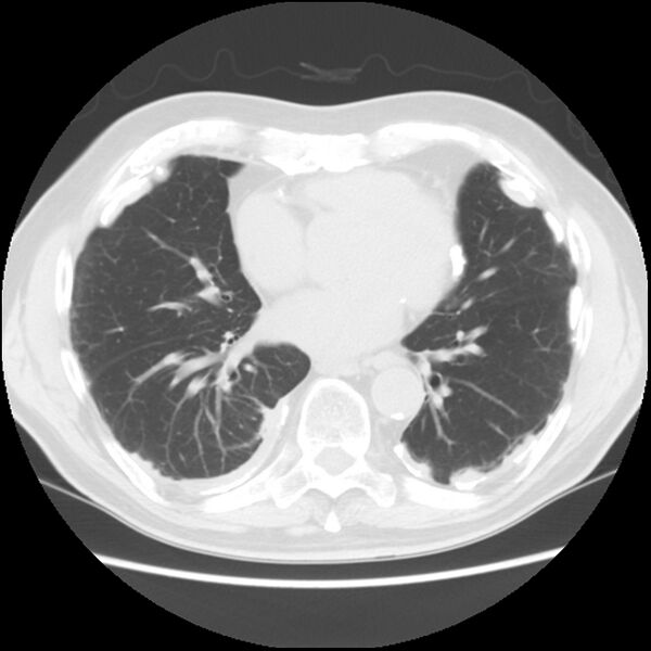 File:Asbestos-related pleural plaques (Radiopaedia 39069-41255 Axial lung window 46).jpg