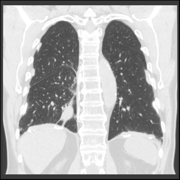 File:Asbestos-related pleural plaques (Radiopaedia 39069-41255 Coronal lung window 24).jpg