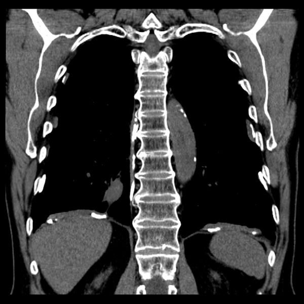 File:Asbestos-related pleural plaques (Radiopaedia 39069-41255 Coronal non-contrast 22).jpg