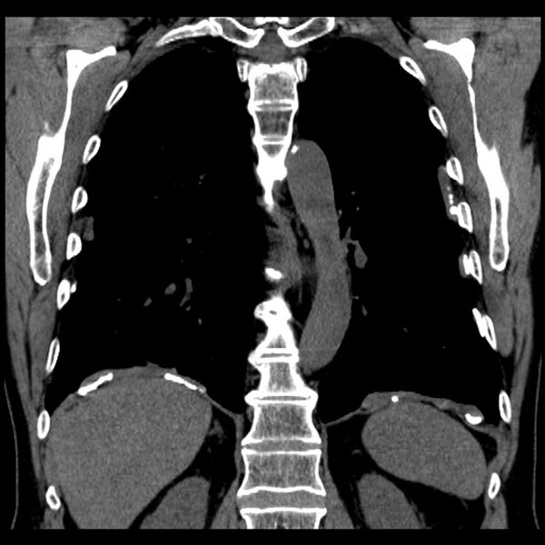 File:Asbestos-related pleural plaques (Radiopaedia 39069-41255 Coronal non-contrast 28).jpg