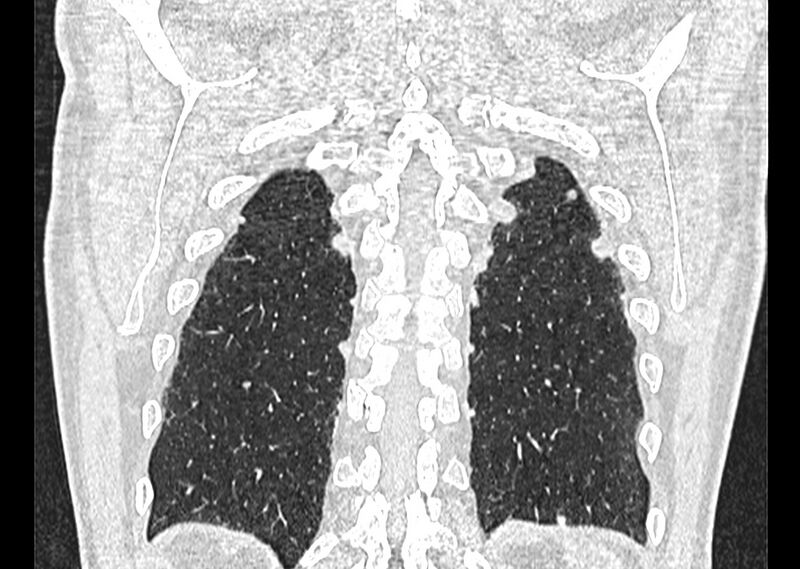 File:Asbestos pleural placques (Radiopaedia 57905-64872 Coronal lung window 250).jpg