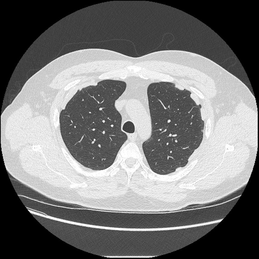 Asbestosis (Radiopaedia 45002-48961 Axial lung window 14).jpg