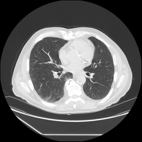 File:Asbestosis complicated by lung cancer (Radiopaedia 45834-50116 Axial lung window 39).jpg
