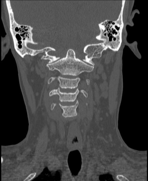 File:Atlanto-occipital assimilation with basilar invagination (Radiopaedia 70122-80188 Coronal bone window 88).jpg