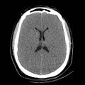 Atlanto-occipital dislocation (Radiopaedia 44648-48412 Axial non-contrast 33).jpg
