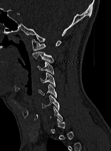 File:Atlantoaxial subluxation (Radiopaedia 44681-48450 Sagittal bone window 16).jpg