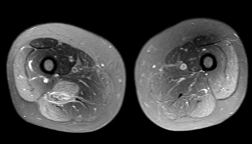 Atypical lipomatous tumor - thigh (Radiopaedia 68975-78734 Axial PD fat sat 52).jpg