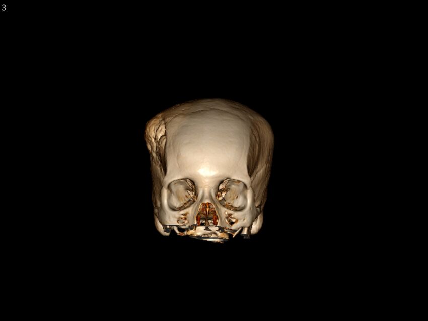 Atypical meningioma - intraosseous (Radiopaedia 64915-73867 3D volume render 3).jpg