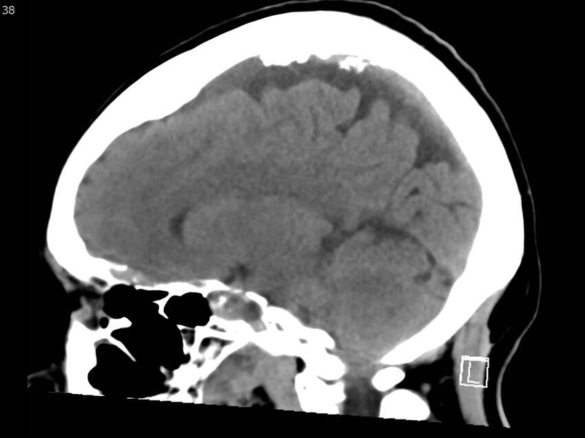 Atypical meningioma - intraosseous (Radiopaedia 64915-73867 C 36).jpg