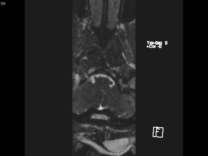 File:Atypical meningioma - intraosseous (Radiopaedia 64915-74572 Axial CISS 59).jpg