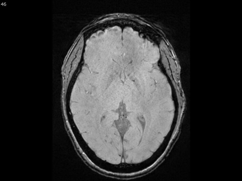 Atypical meningioma - intraosseous (Radiopaedia 64915-74572 Axial SWI 46).jpg