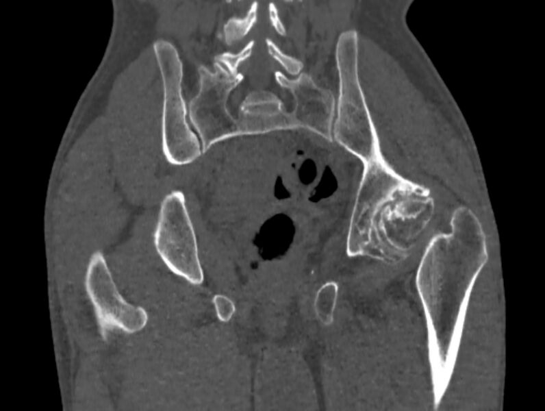File:Avascular necrosis of the left hip (Radiopaedia 75068-86125 Coronal bone window 63).jpg